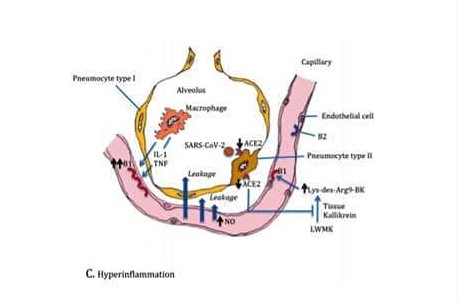Gambar 2: Covid-19 mengoyak-ngoyak gelembung alveolar paru dan pembuluh kapiler darah.