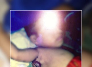 Sulit Dapat Surat Keterangan Miskin, Pasien Balita Tumor Jinak di Alor Terlantar Pasien Fiana Soares Maggi yang divonis dokter terserang lipoma atau tumor jinak di bawah bahu kanannya.