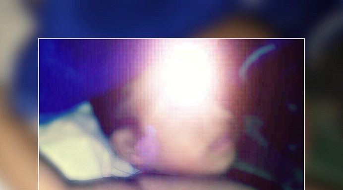 Sulit Dapat Surat Keterangan Miskin, Pasien Balita Tumor Jinak di Alor Terlantar Pasien Fiana Soares Maggi yang divonis dokter terserang lipoma atau tumor jinak di bawah bahu kanannya.